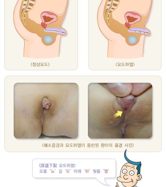 소아 왜소음경 & 함몰음경 ; 멘파워비뇨기과 인천점 : 네이버 블로그