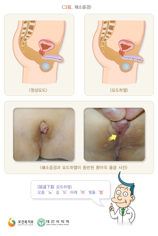 소아 왜소음경 & 함몰음경 ; 멘파워비뇨기과 인천점 : 네이버 블로그