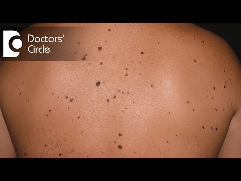 Are irregular, dark brown birthmarks all over breast and stomach normal? - Dr. Sudheendra Udbalker