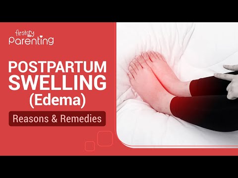Postpartum Swelling (Edema) - Reasons and Remedies