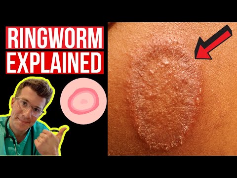 Doctor explains Ringworm (aka Tinea) including symptoms, signs, causes and treatment!