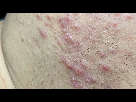 Jawline Acne | Mụn Vùng Quai Hàm  - SacDepSpa#258