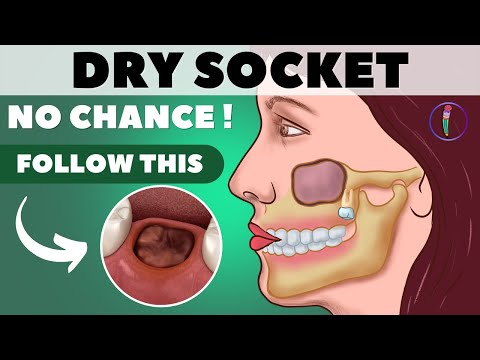 Tooth extraction aftercare I Wisdom tooth extraction - Tips for faster healing & prevent dry socket